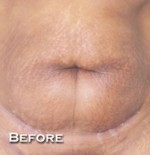 Tummy Tuck (Abdominoplasty)