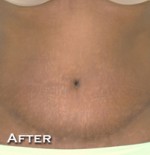 Tummy Tuck (Abdominoplasty)