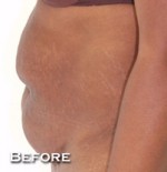 Tummy Tuck (Abdominoplasty)