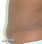Tummy Tuck (Abdominoplasty)