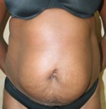 Tummy Tuck (Abdominoplasty)