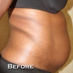 Tummy Tuck (Abdominoplasty)