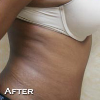 Tummy Tuck (Abdominoplasty)
