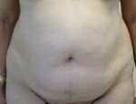 Tummy Tuck (Abdominoplasty)