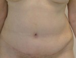 Tummy Tuck (Abdominoplasty)