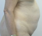 Tummy Tuck (Abdominoplasty)