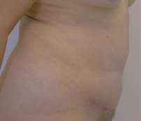 Tummy Tuck (Abdominoplasty)