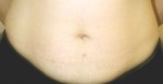 Tummy Tuck (Abdominoplasty)
