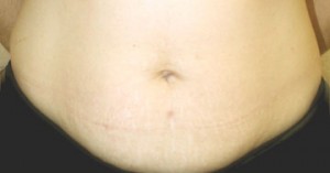 Tummy Tuck (Abdominoplasty)