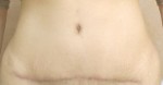 Tummy Tuck (Abdominoplasty)