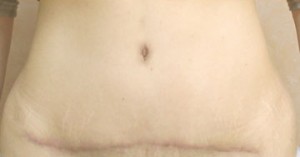 Tummy Tuck (Abdominoplasty)