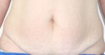 Tummy Tuck (Abdominoplasty)