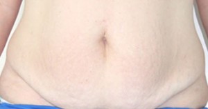 Tummy Tuck (Abdominoplasty)