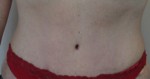 Tummy Tuck (Abdominoplasty)
