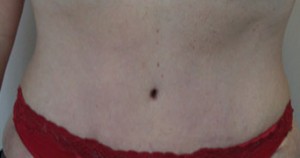 Tummy Tuck (Abdominoplasty)