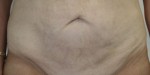 Tummy Tuck (Abdominoplasty)
