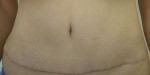 Tummy Tuck (Abdominoplasty)