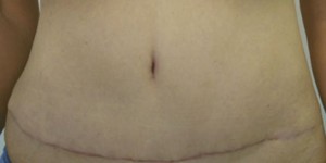 Tummy Tuck (Abdominoplasty)