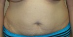 Tummy Tuck (Abdominoplasty)