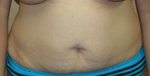 Tummy Tuck (Abdominoplasty)