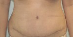 Tummy Tuck (Abdominoplasty)