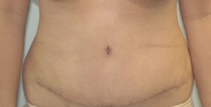 Tummy Tuck (Abdominoplasty)