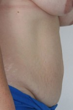 Tummy Tuck (Abdominoplasty)