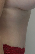 Tummy Tuck (Abdominoplasty)