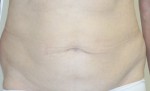 Tummy Tuck (Abdominoplasty)