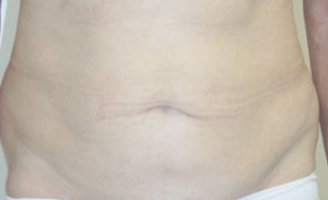Tummy Tuck (Abdominoplasty)