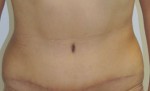 Tummy Tuck (Abdominoplasty)