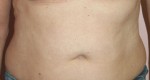 Tummy Tuck (Abdominoplasty)