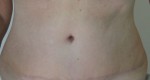 Tummy Tuck (Abdominoplasty)