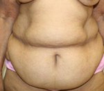 Tummy Tuck (Abdominoplasty)