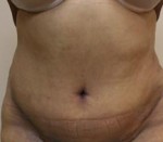 Tummy Tuck (Abdominoplasty)