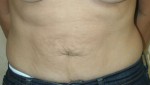 Tummy Tuck (Abdominoplasty)