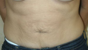 Tummy Tuck (Abdominoplasty)