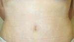 Tummy Tuck (Abdominoplasty)
