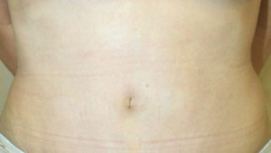 Tummy Tuck (Abdominoplasty)