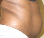 Tummy Tuck (Abdominoplasty)