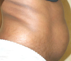 Tummy Tuck (Abdominoplasty)