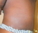 Tummy Tuck (Abdominoplasty)