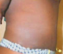 Tummy Tuck (Abdominoplasty)