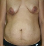 Tummy Tuck (Abdominoplasty)