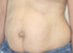Tummy Tuck (Abdominoplasty)