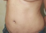 Tummy Tuck (Abdominoplasty)