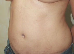Tummy Tuck (Abdominoplasty)