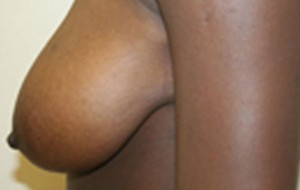 Breast Lift (Mastopexy)