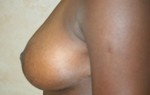 Breast Lift (Mastopexy)