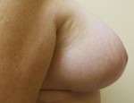 Breast Lift (Mastopexy)